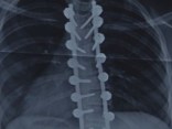 Robot Helps Plan Back Surgeries