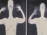 Radiation Concerns in Body Scanners
