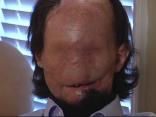 Burn Patient Hopes to Become Face Transplant Case