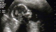 Texas Senate Drops 20-Week Abortion Ban