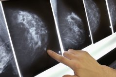 Begin Mammograms at 40: SGK for the Cure