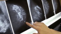 State Finds Violations at Mammogram Centers