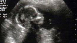 Texas Senate Drops 20-Week Abortion Ban