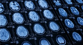 Stroke Treatment Window Widens