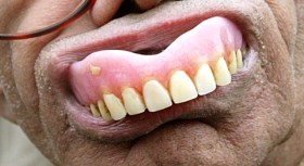 Overuse of Denture Cream with Zinc Sparks Lawsuits