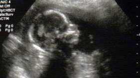 Texas Senate Drops Abortion Ban After 20 Weeks