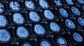 Stroke Treatment Window Widens
