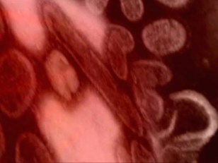 Flu 'Widespread' Across Texas