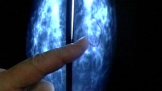 Stress Might Trigger More Aggressive Breast Cancer