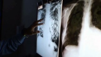 Doctors Answer TB Questions