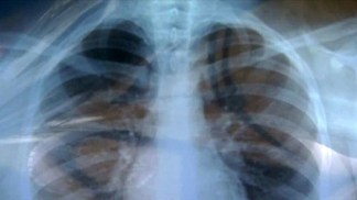 Doctor: Students With Positive TB Skin Test Shouldn't Panic