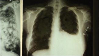 Dallas Students Take TB Tests