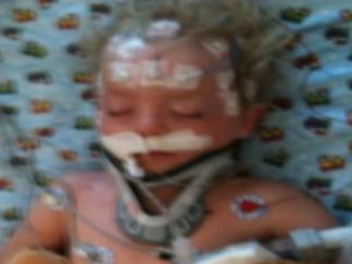 Rare Procedure Saves 4-Year-Old