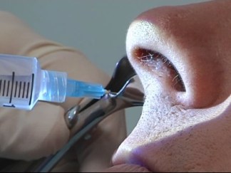 Patients Rave Over 10-Minute Procedure That Cures Allergy Woes