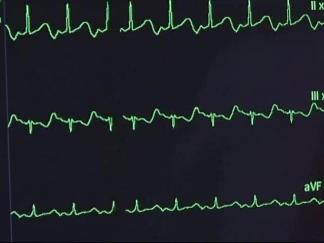 New Tech Offers New Hope for Heart Attack Victims