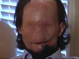 Burn Patient Hopes to Become Face Transplant Case