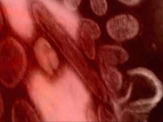 Richardson Teen With Swine Flu Dies