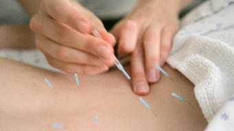 Study: Acupuncture Helps with Pain