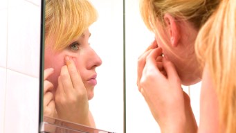Battling Adult Acne
