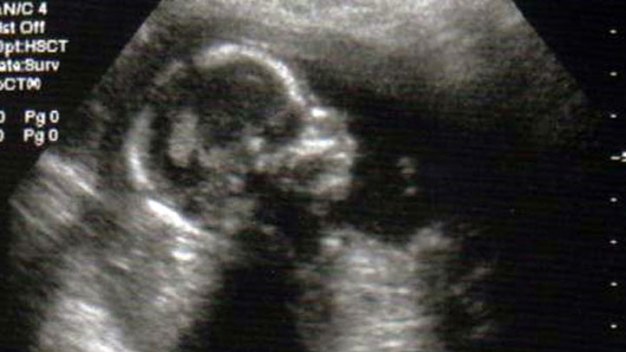Texas Senate Drops Abortion Ban After 20 Weeks