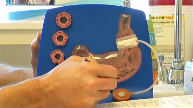 60,000 North Texans are no eligible for lap band surgery thanks to new <a title=