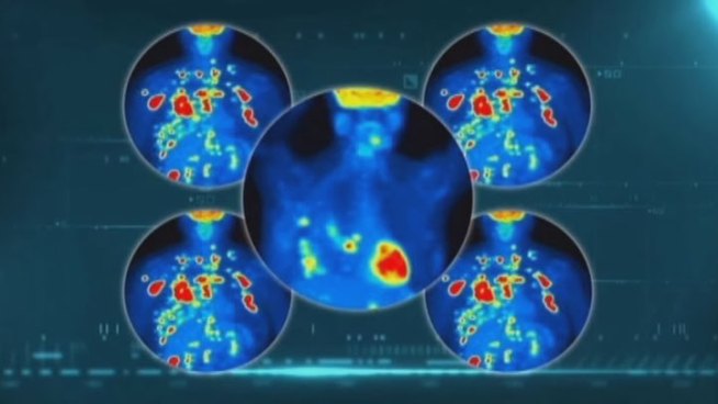 Officials with Susan G Komen for the Cure say a new study that found there are four main types of breast cancer is a big step towards finding a cure.
