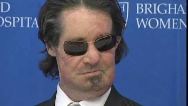 One year after receiving the nation's first full-face transplant, Dallas Wiens talks about his transformation and recovery.