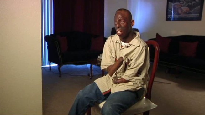 A North Texas man says Six Flags Over Texas would not let him ride any roller coasters because he does not have hands.