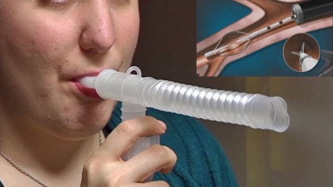 Doctors at Texas Health Dallas are offering one of the newest techniques in the treatment of asthma the 45-minute procedure is called bronchial thermoplasty.