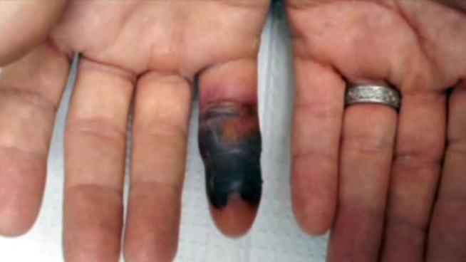A Colleyville man bitten by a copperhead two weeks ago was treated with anti-venom and spent three days in a hospital.