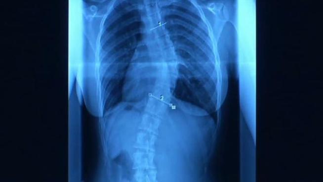 A genetic test for scoliosis can help predict the likely progression of a curve if left untreated.