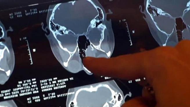 A North Texas woman says her fight with sinus cancer started with what she thought was a sinus infection.