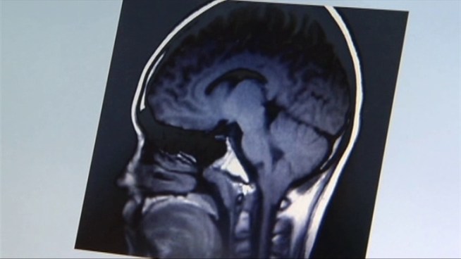 Three siblings are diagnosed with the same rare brain disorder.