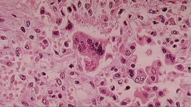 The Center For Disease Control says several people across the country who have measles went to an air show in Orlando, Fla., last month.