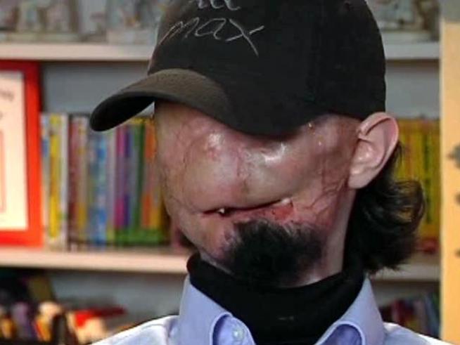 A man burned during a construction accident hopes to become the third person in the United States to have a face transplant.