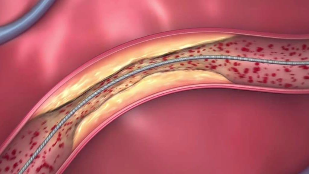 Absorbable Stents Right For Some, According to Doctors