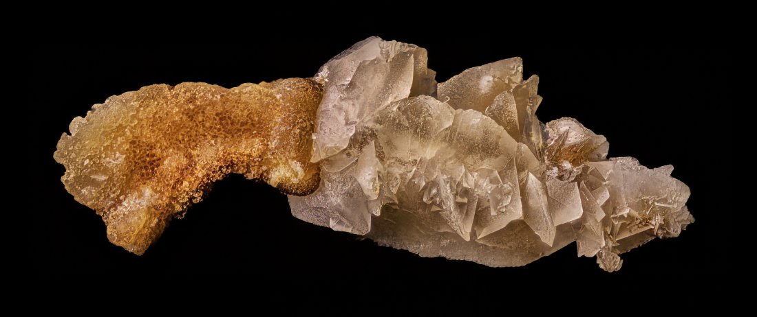 A kidney stone