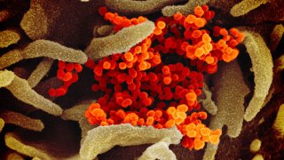 This scanning electron microscope image shows SARS-CoV-2 (orange)—also known as 2019-nCoV, the virus that causes COVID-19