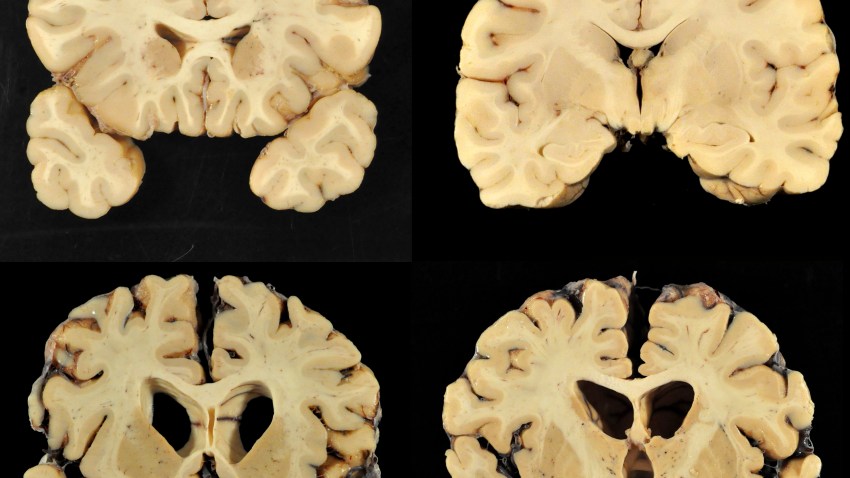 Science Says Football Brain Disease