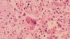 Doctors issue measles warning as cases rise across the U.S.