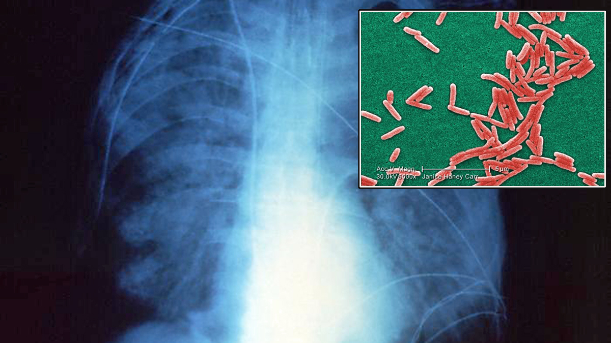 What is Legionnaires’ disease?