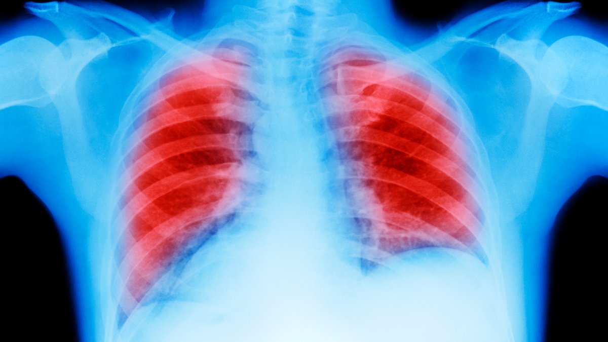 Double Lung Transplants Saves 2 Late-Stage Cancer Patients – NBC 5 Dallas-Fort Worth - Vimarsana News