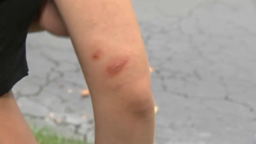Mysterious bug bites on Morgan Dailey's arm