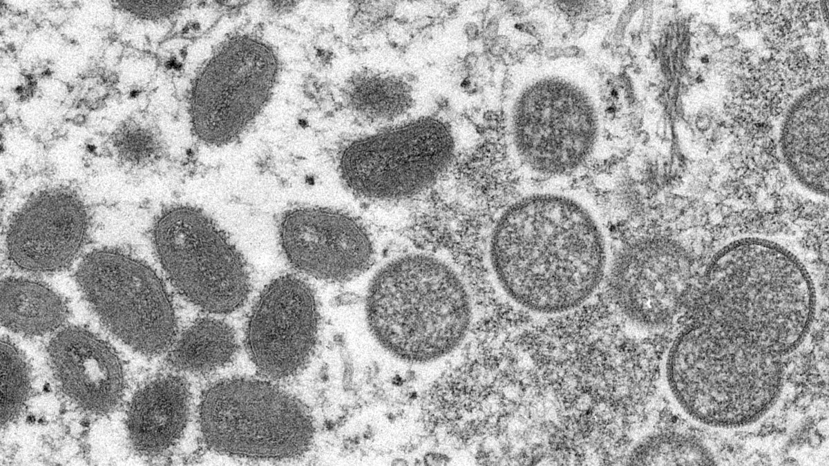 Monkeypox Virus Could Become Entrenched STD in the US - Vimarsana News