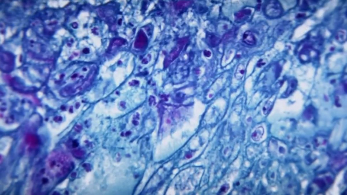 CDC, HHS, and White House Hold Briefing on Monkeypox Investigation - Vimarsana News