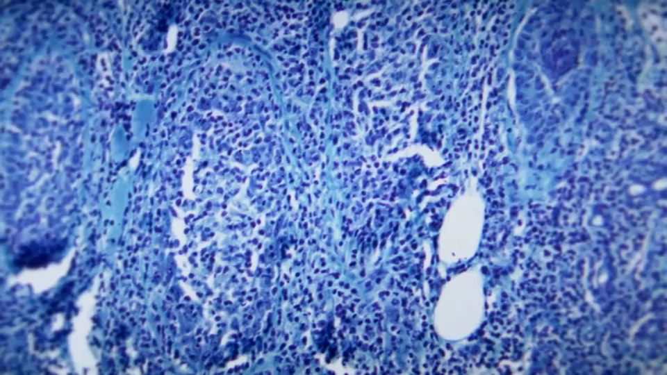 Affenpockenfälle in Dallas County erreichen 14, einschließlich lokaler Übertragung – NBC 5 Dallas-Fort Worth Affenpockenfälle in Dallas County erreichen 14, einschließlich lokaler Übertragung – NBC 5 Dallas-Fort Worth