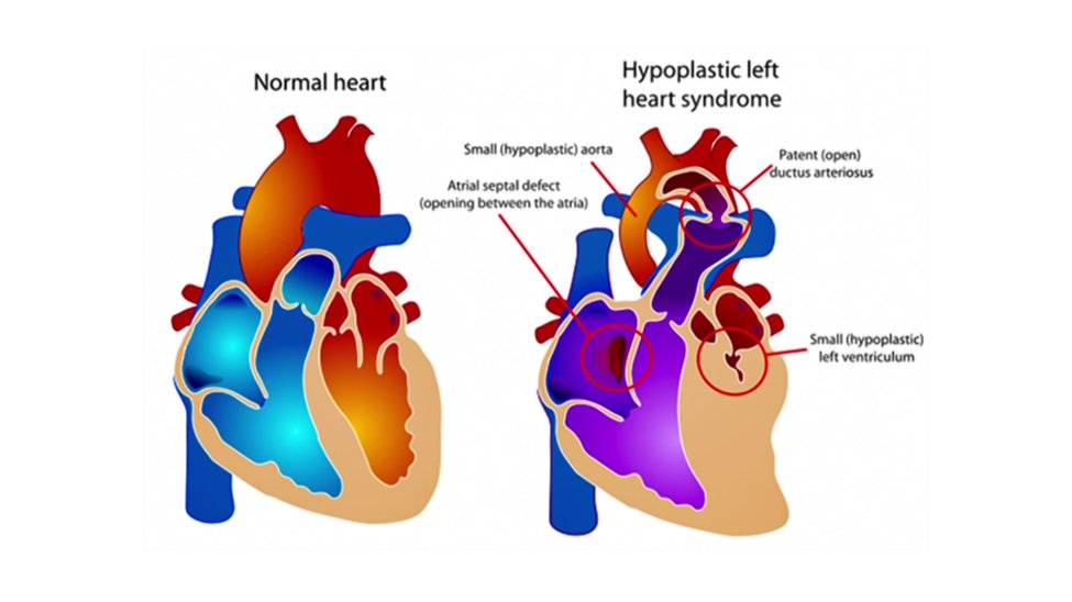 Stem Cells Used to Repair Heart Defects in Children