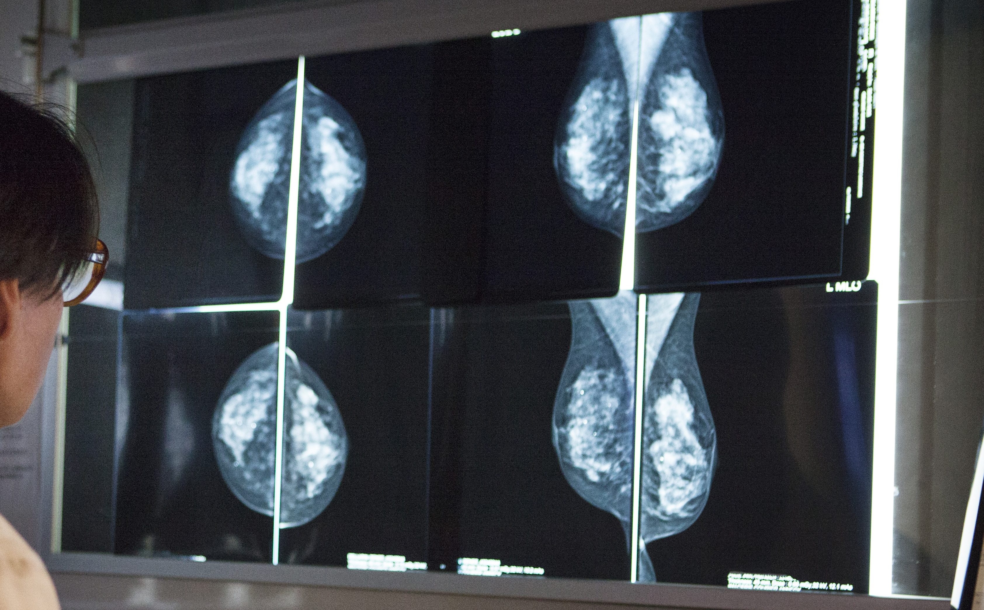 What Does it Mean to Have Stage 1A Breast Cancer? – NBC 5 Dallas-Fort Worth - Vimarsana News