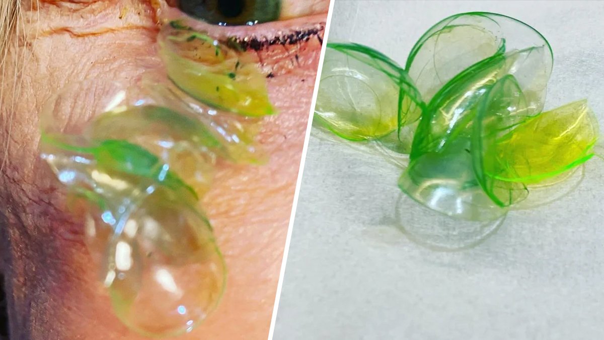 Woman Had 23 Contact Lenses Stuck Under Her Eyelid, Doctor Says – NBC 5 Dallas-Fort Worth - Vimarsana News