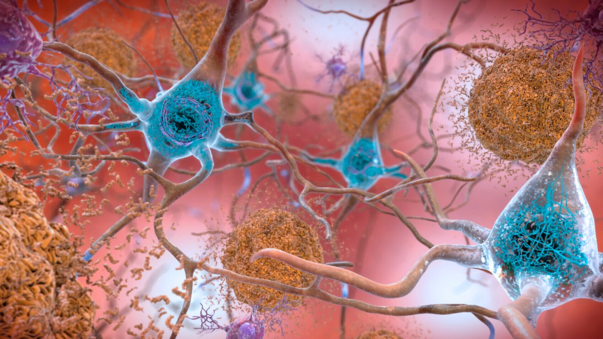 New Drug Shows Signs of Slowing Cognitive Decline in Alzheimer’s Patients, Study Finds